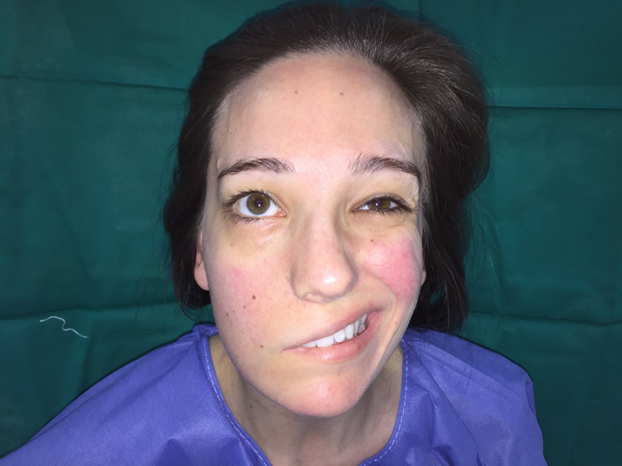 Parálisis facial completa — 14 meses