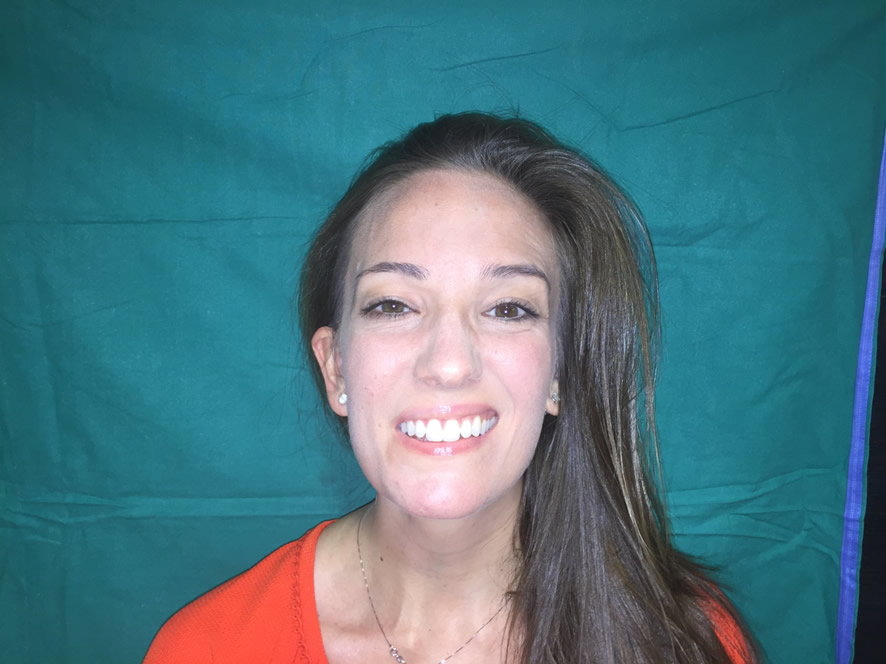 Resultado 2 años — función casi simétrica