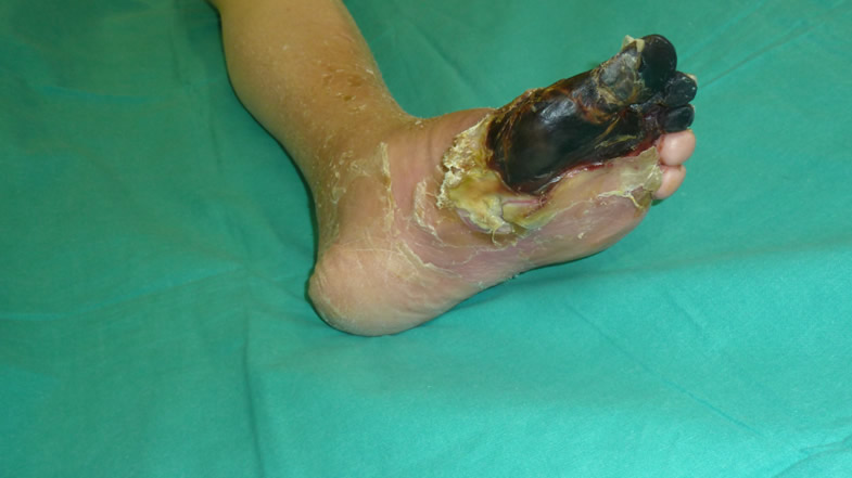 Necrosis pie diabético — estado inicial