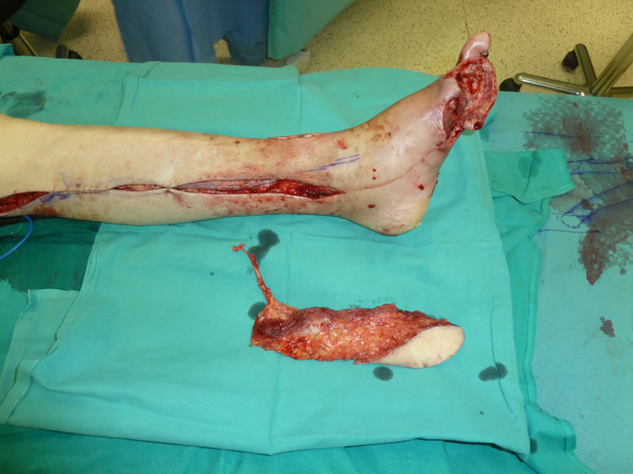 Intraoperatorio — colgajo microvascular y bypass