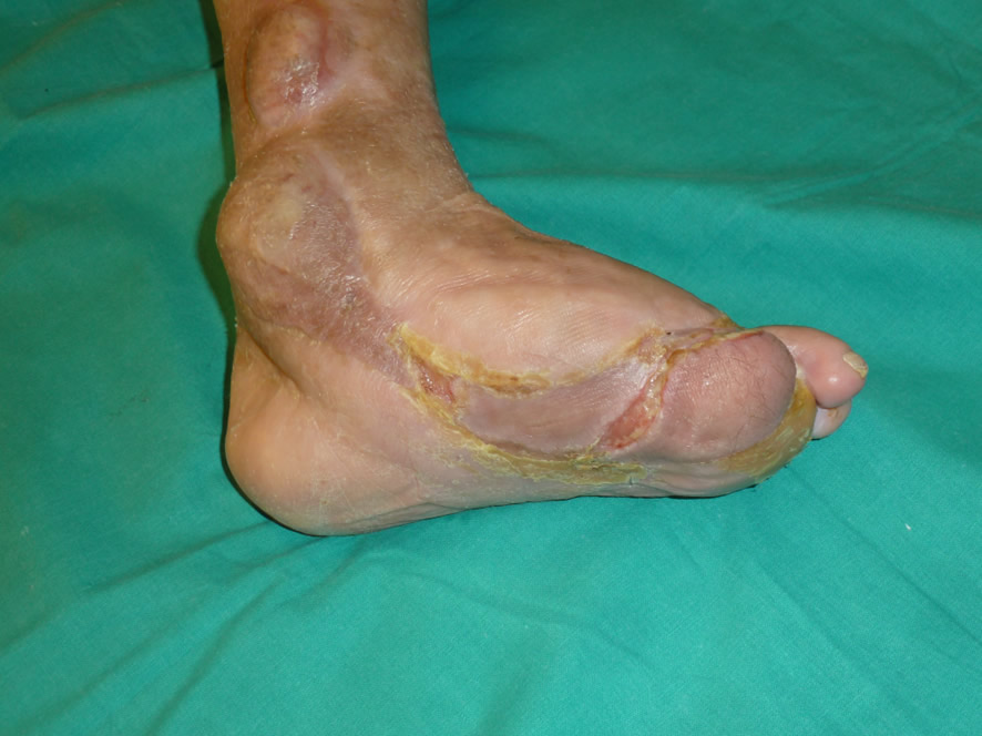 Resultado a los 3 meses — pie preservado