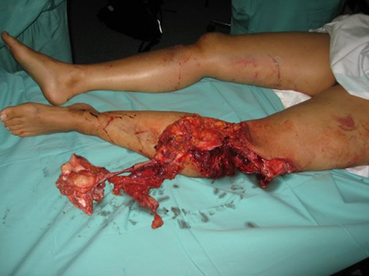 Pierna catastrófica — estado inicial