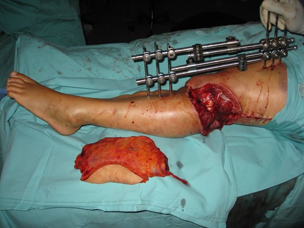 Destrucción de rodilla — estado inicial