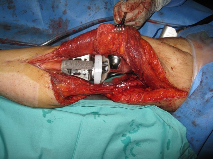 Intraoperatorio pierna catastrófica