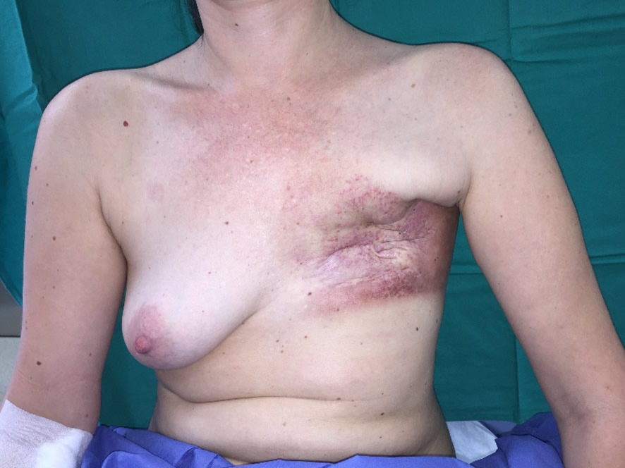 Radionecrosis torácica — estado inicial