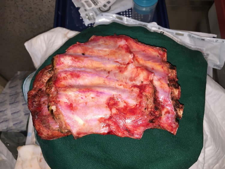 Pieza resecada — pared torácica