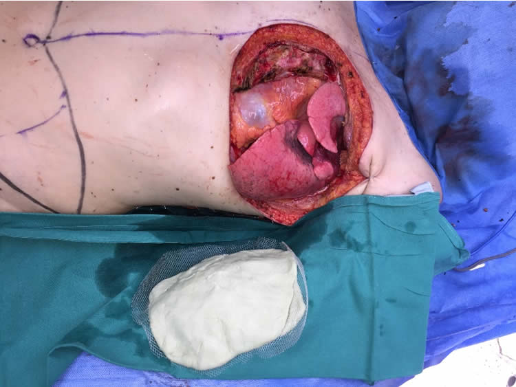 Reconstrucción con malla-metacrilato