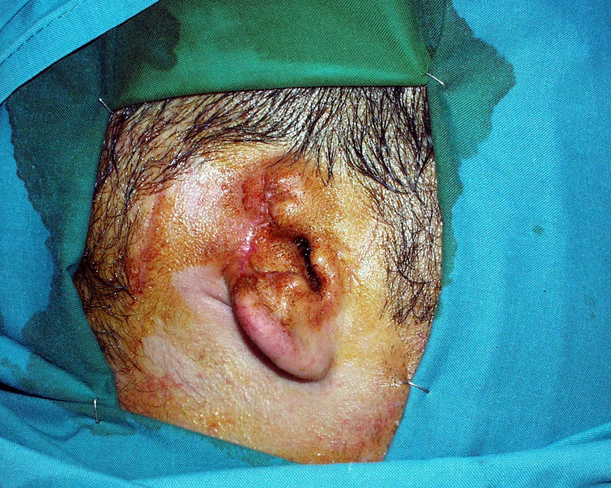 Defecto traumático de oreja — estado inicial