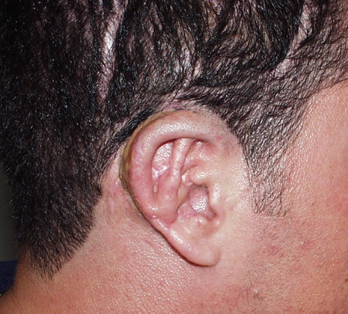 Resultado final a los 8 meses