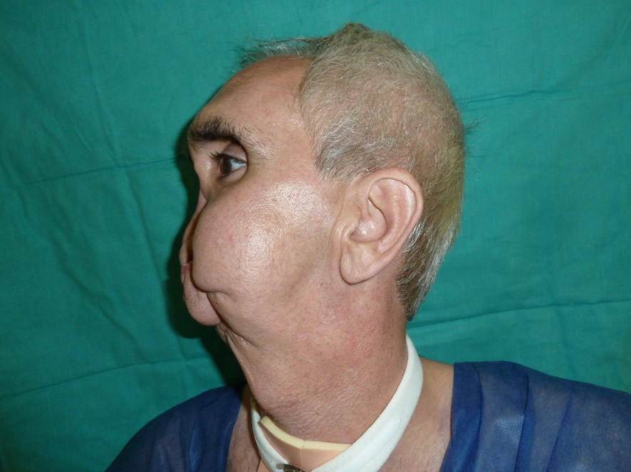 Defecto facial severo — estado inicial