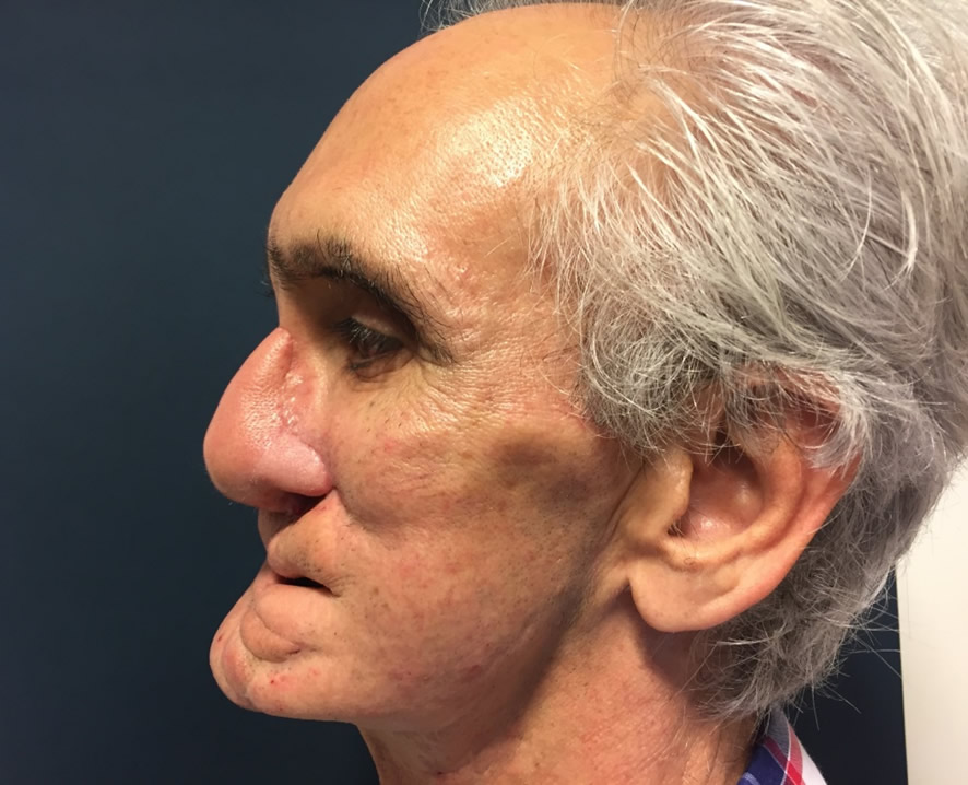 Resultado 3 años — aspecto casi normal