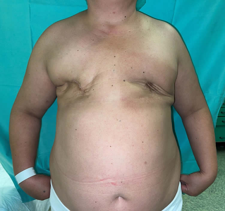 Mastectomía bilateral irradiada — estado inicial