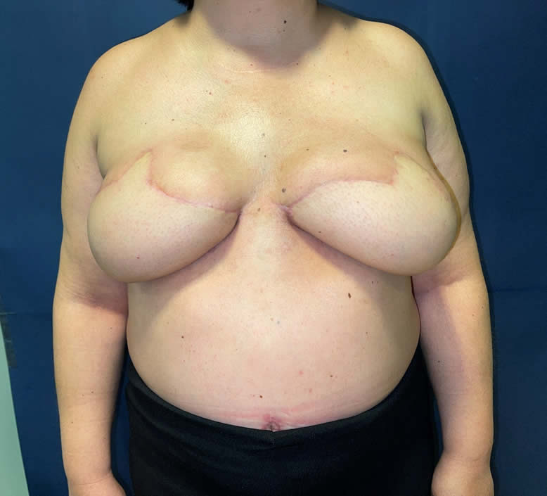 Resultado 6 meses — simetría bilateral