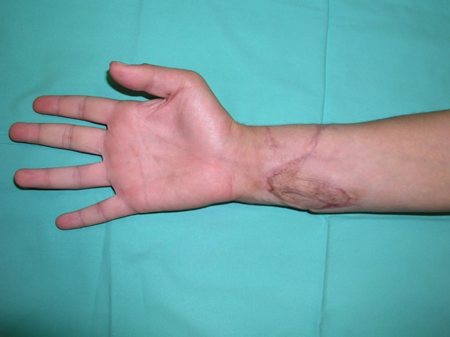 Resultado funcional a los dos años