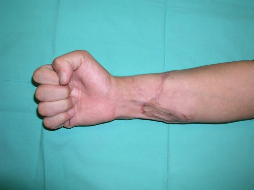 Resultado funcional a los dos años (2)