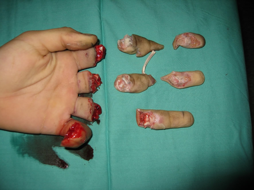 Amputación multidigital multisegmento — estado inicial