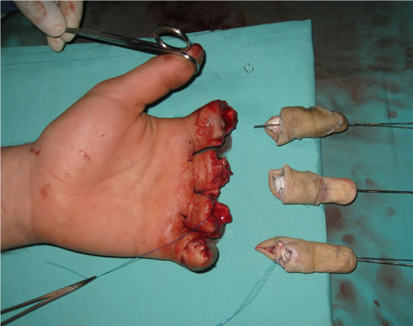 Dedos reconstruidos previo al reimplante