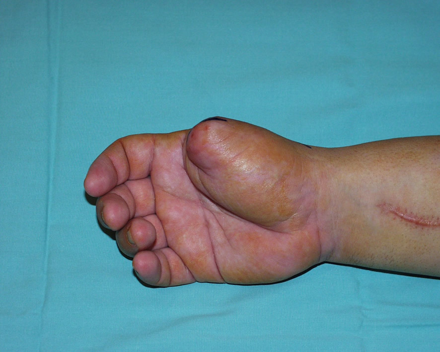 Secuela amputación metacarpofalángica del pulgar
