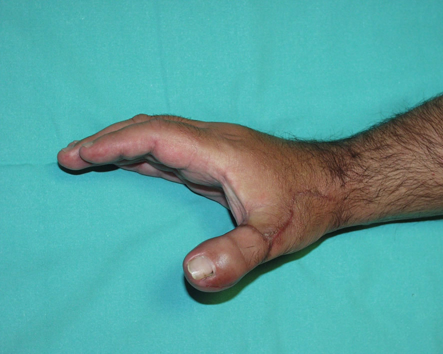 Reconstrucción con wrap around microquirúrgico de dedo de pie