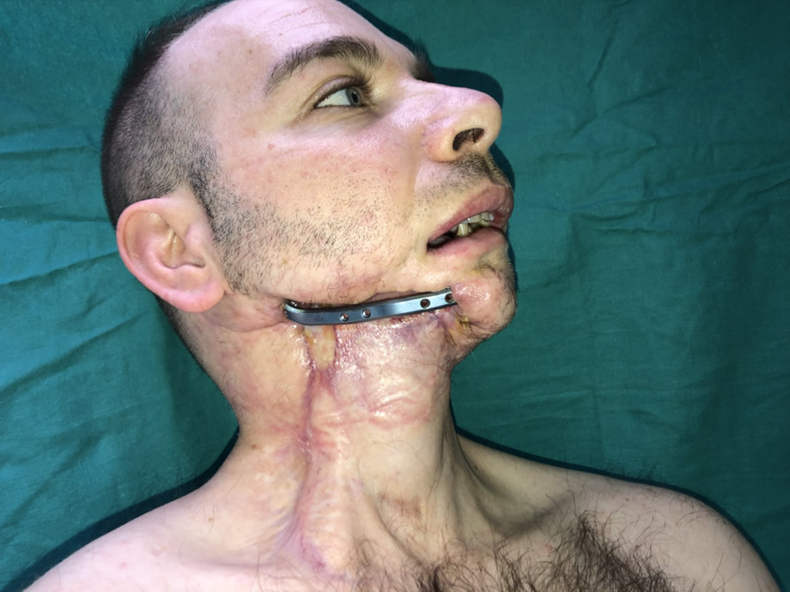 Defecto mandibular — estado inicial