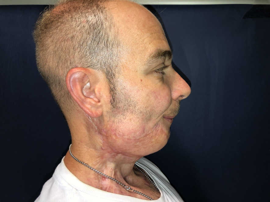 Resultado 2 años — mandíbula reconstruida
