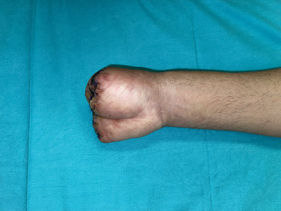 Preop mano metacarpiana tipo II