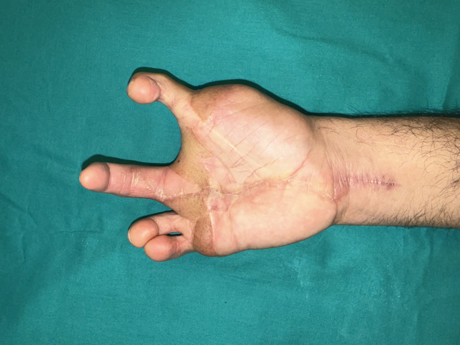 Postop — reconstrucción con dedos de pie y mano contralateral