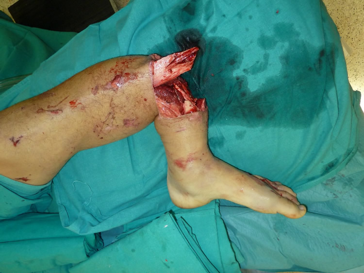 Traumatismos y fracturas abiertas - Antes