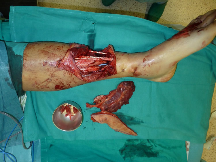 Traumatismos y fracturas abiertas - Antes