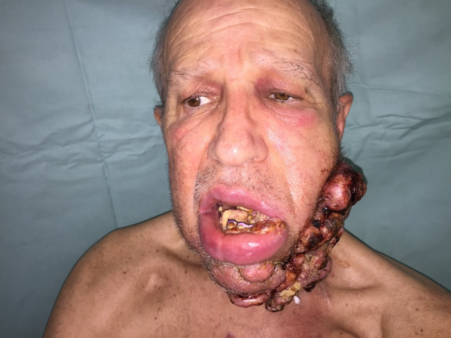 Estado preoperatorio — masa tumoral