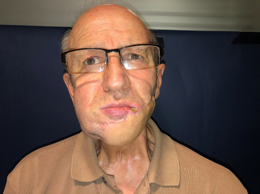 Postop 6 años — curado