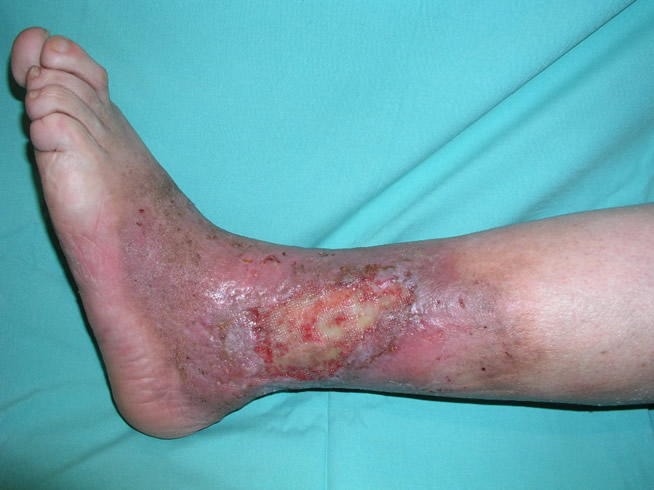 Úlceras venosas — estado inicial