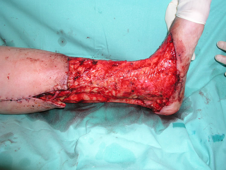 Resección radical 360º — intraoperatorio