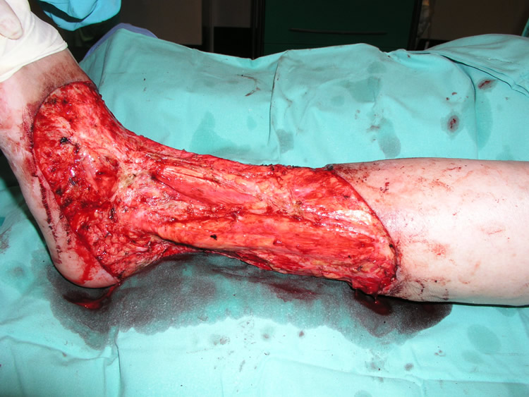 Resección radical 360º — intraoperatorio (2)