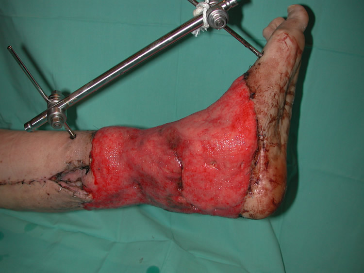 Postop 10 días — epiplón granulado