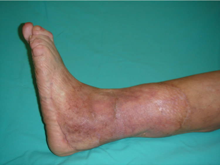 Postop 10 años — integridad completa de la piel